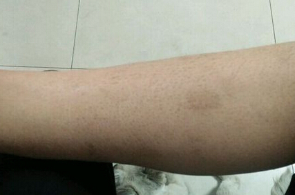 腿上的鱼鳞病