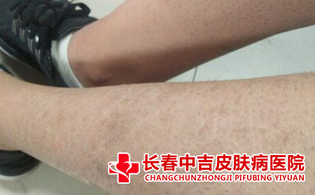 鱼鳞病症状
