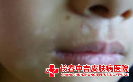 白斑病症