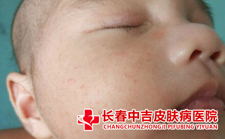 宝宝腮部的湿疹接连不断