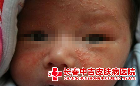 宝宝湿疹症状