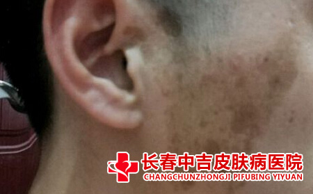 脸上的胎记如何去除
