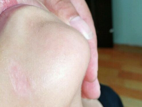 冷冻过后胎记还是比较明显