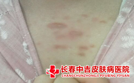 胸前的瘢痕不知道能不能去掉