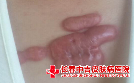 瘢痕的病症