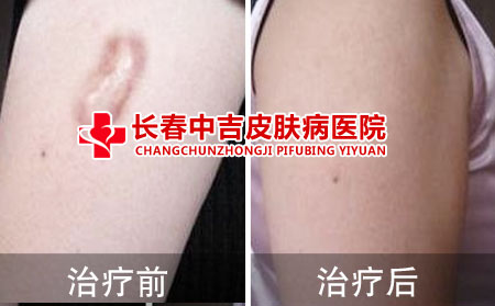 瘢痕治疗前后对比