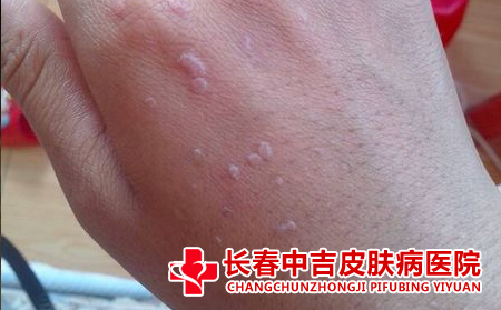扁平庞症状
