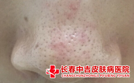 酒槽鼻应该有针对性的治疗