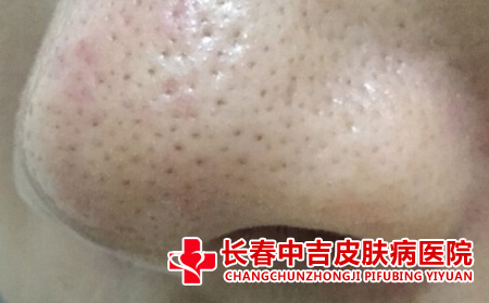 炎症性酒槽鼻