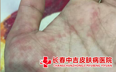 手部的荨麻疹通红一片