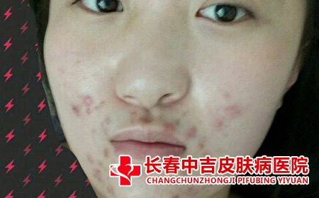 因情绪失控导致嘴角爆痘