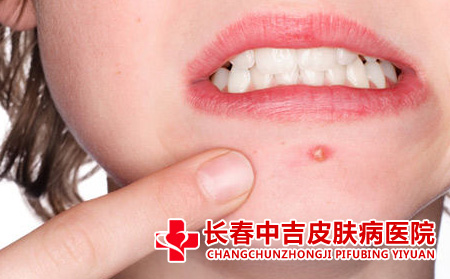 青春痘应该怎么进行治疗