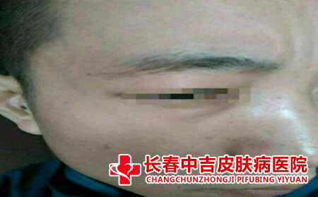 毛囊炎恢复之后