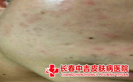 毛囊炎痘痘