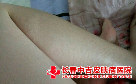 鱼鳞病的症状