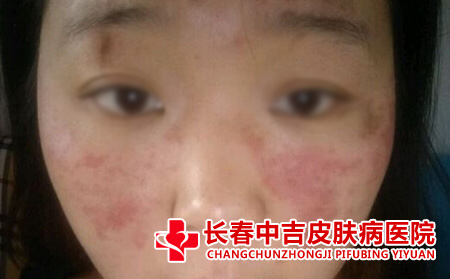 面部红斑狼疮症状