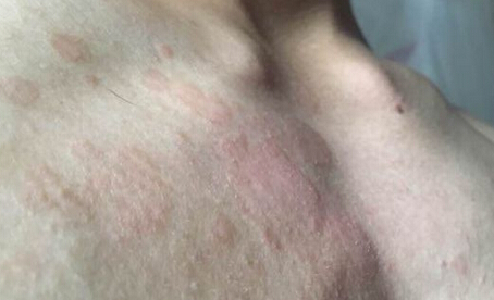 红斑狼疮症状判断