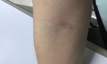 如何判断红斑狼疮