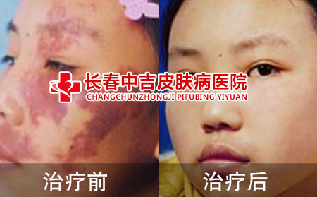 红斑狼疮治疗前后对比