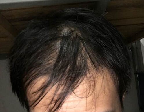 脱发导致发髻线偏高