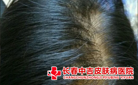 脱发过于严重