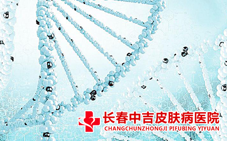 牛皮癣患者的治疗方式有什么