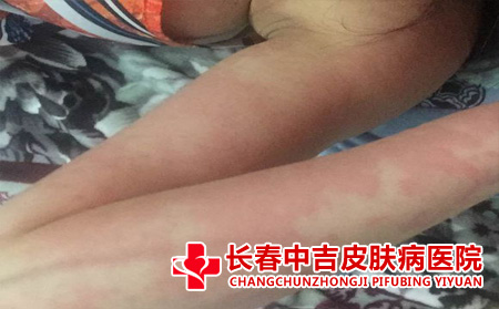 荨麻疹病症