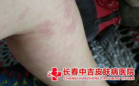 腿上的红胎记