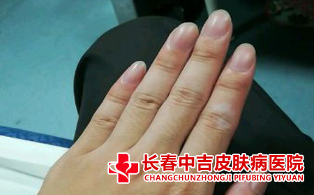 手部的白癜风