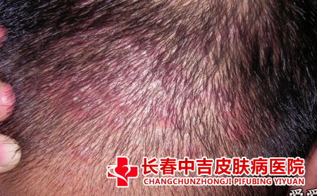 毛囊炎病症