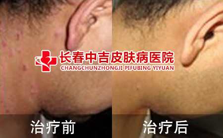 毛囊炎治疗前后对比