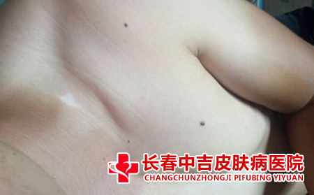 身上的白癜风症状