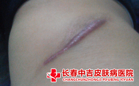 瘢痕体质