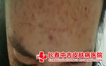 额头上的痘痘