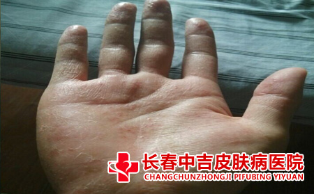 手上的疱疹症状