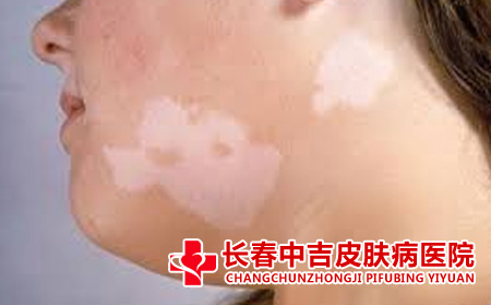 白癜风患者合适怎么进行治疗