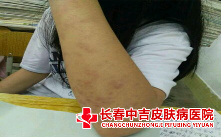 红斑狼疮症状检测