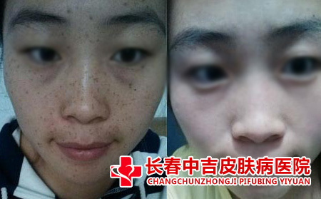 面部黄褐斑前后对比