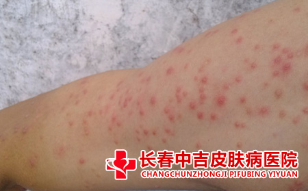 湿疹的治疗方式有什么