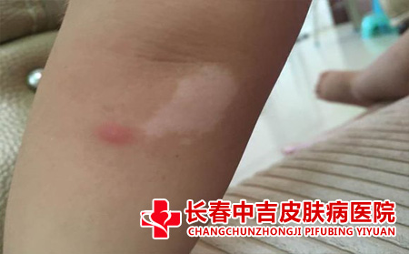 白斑症状