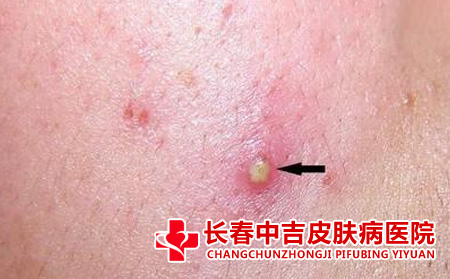 痤疮应该怎么进行治疗