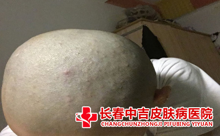 头部毛囊炎症状