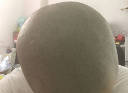 毛囊炎消退了
