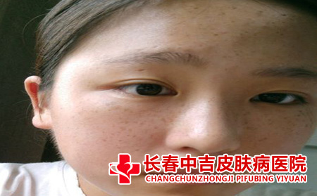 脸上的雀斑