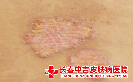 癣的症状