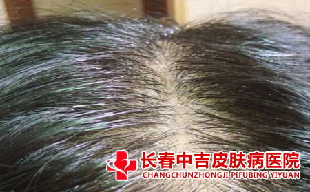 掉发严重