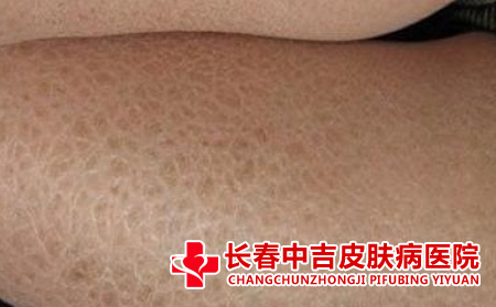 鱼鳞病病症