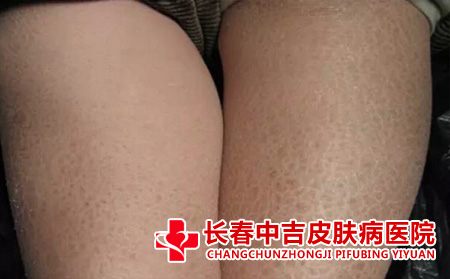 鱼鳞病症状