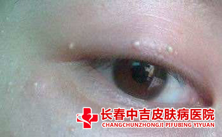 眼角部位的扁平疣