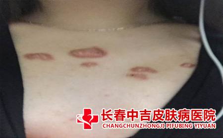 胸前的瘢痕症状